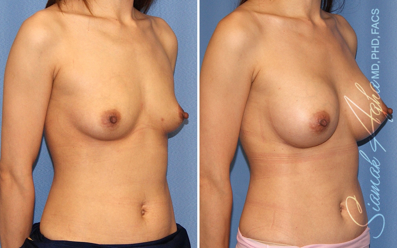 Breast Augmentation Patient 51