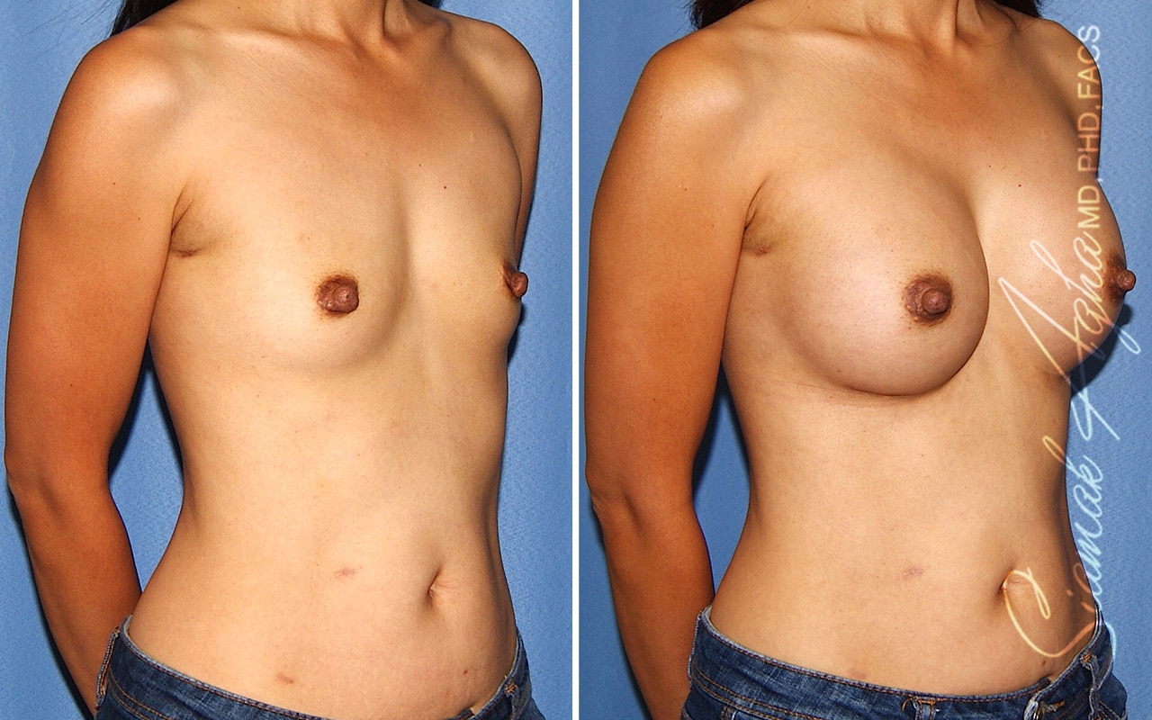 Breast Augmentation Patient 52