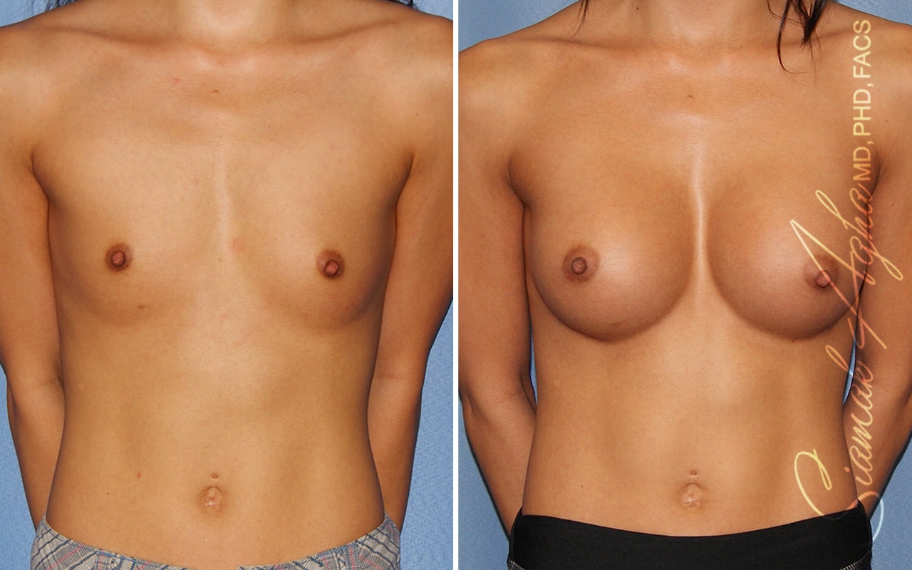 orange county breast augmentation patient 53 front Newport Beach, CA