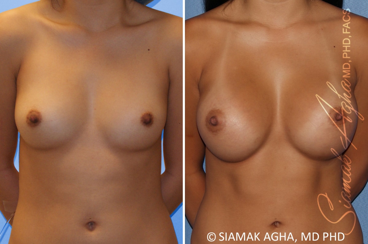 orange county breast augmentation patient 54 front Newport Beach, CA