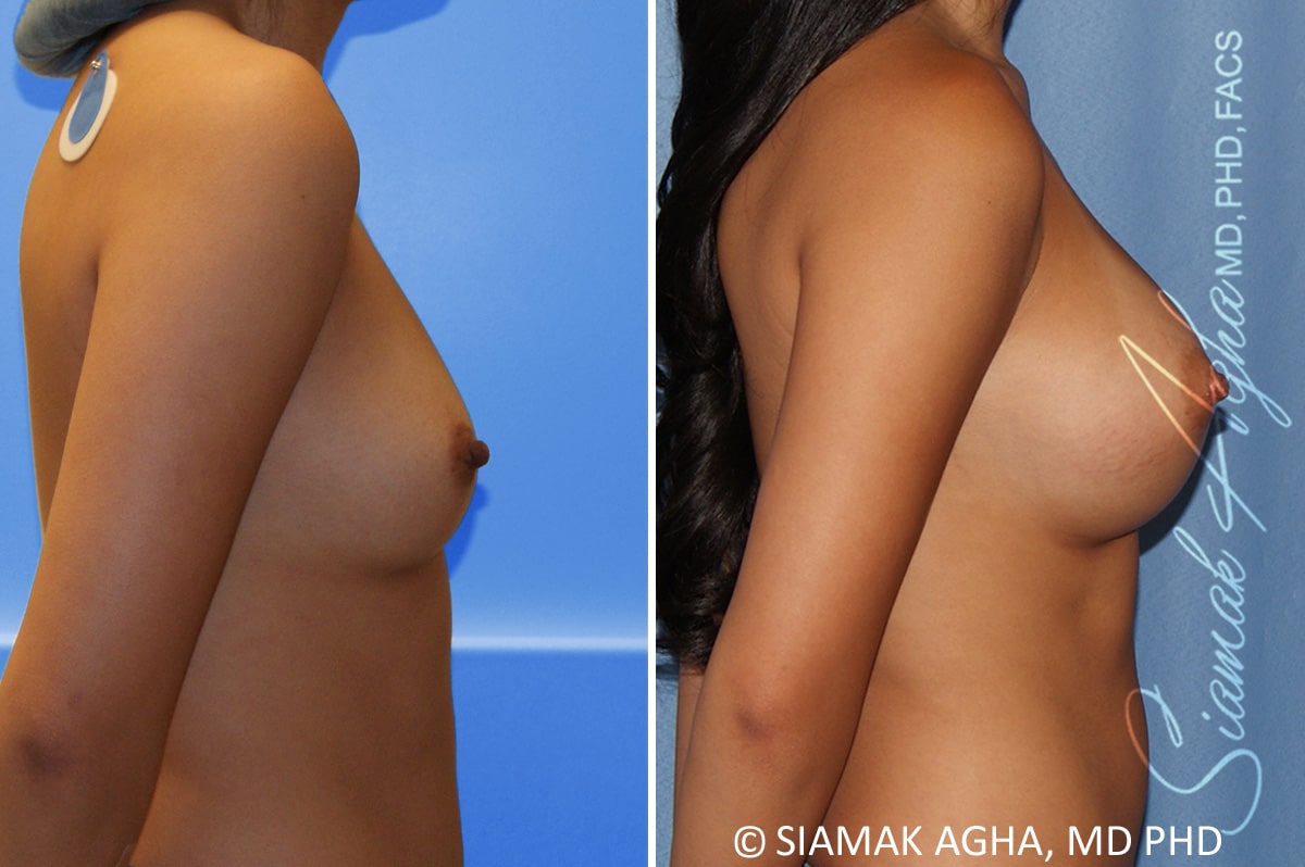 Breast Augmentation Patient 54