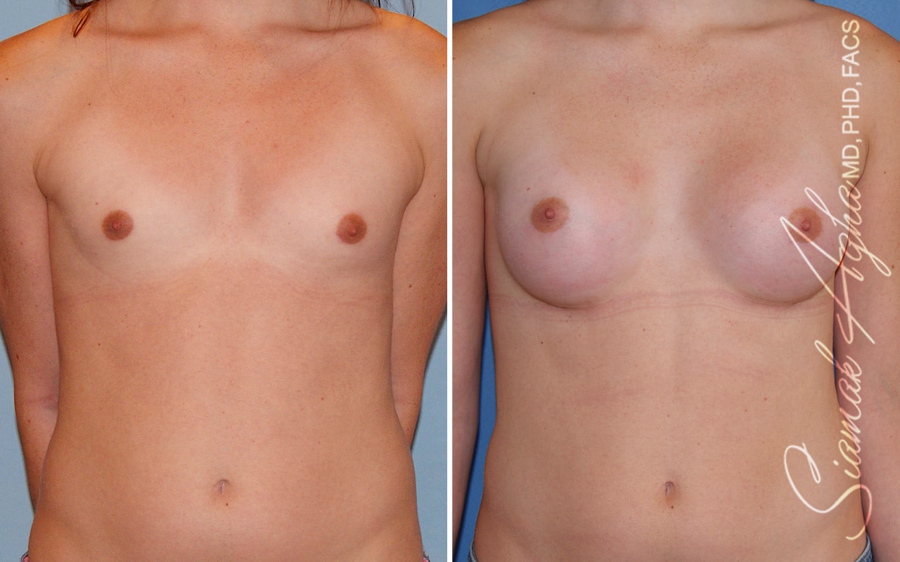 orange county breast augmentation patient 55 front Newport Beach, CA