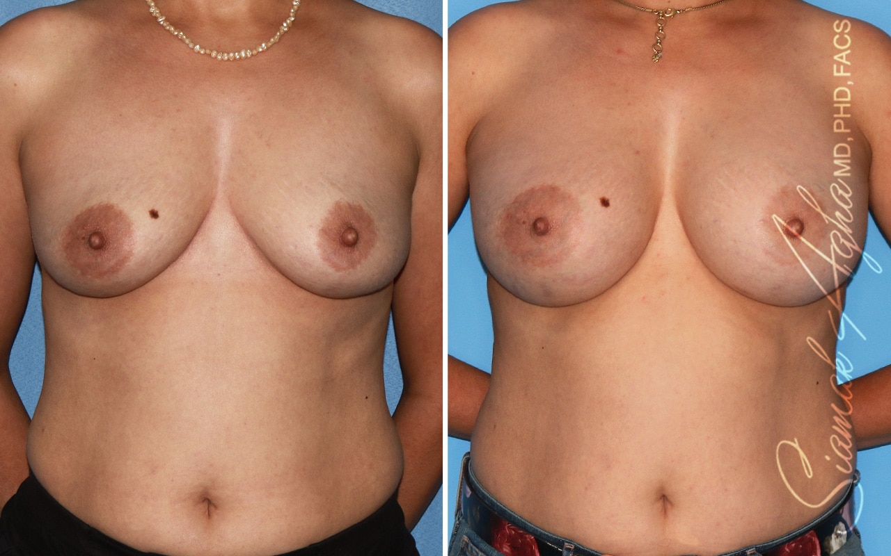 orange county breast augmentation patient 56 front Newport Beach, CA