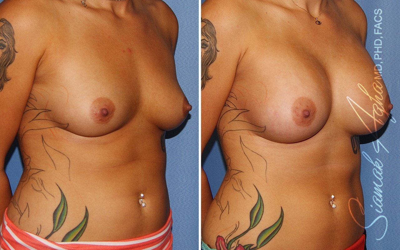 Breast Augmentation Patient 57