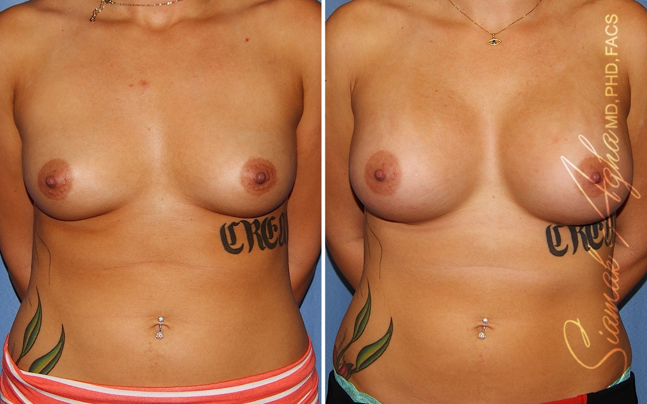 orange county breast augmentation patient 57 front Newport Beach, CA