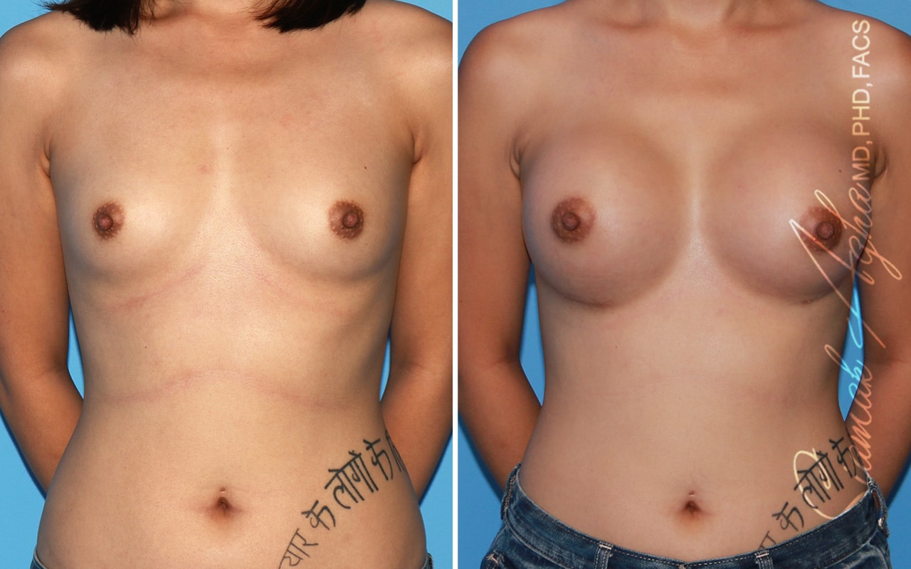 orange county breast augmentation patient 58 front Newport Beach, CA