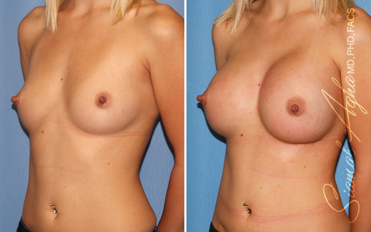 Breast Augmentation Patient 59