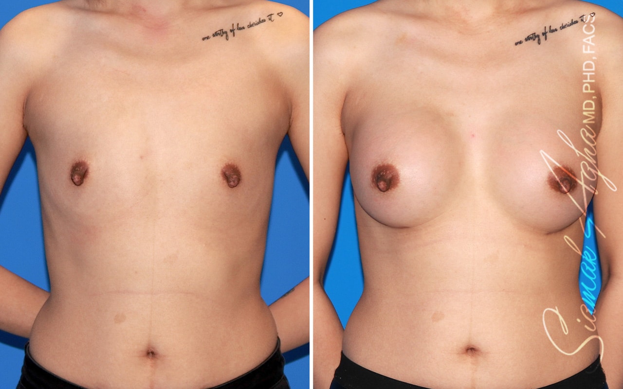 Breast Augmentation Patient 61