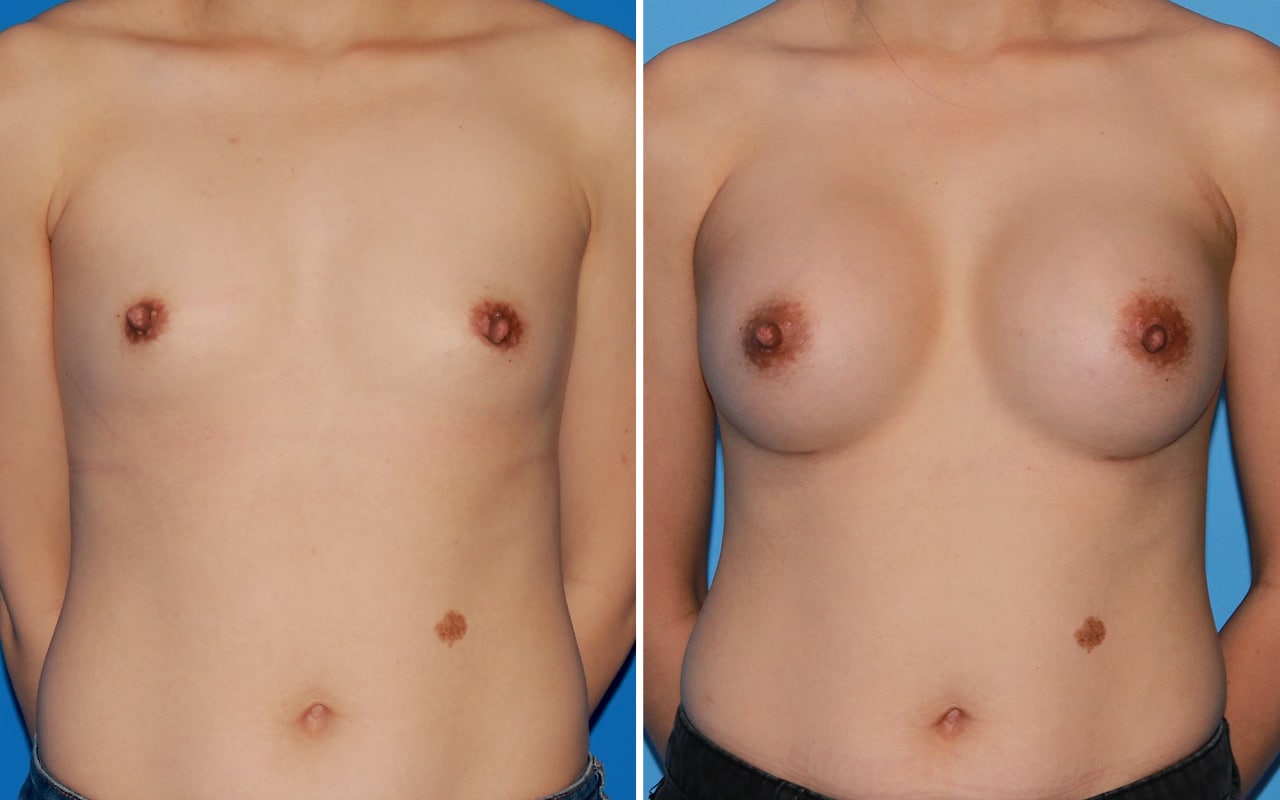 Breast Augmentation Patient 62