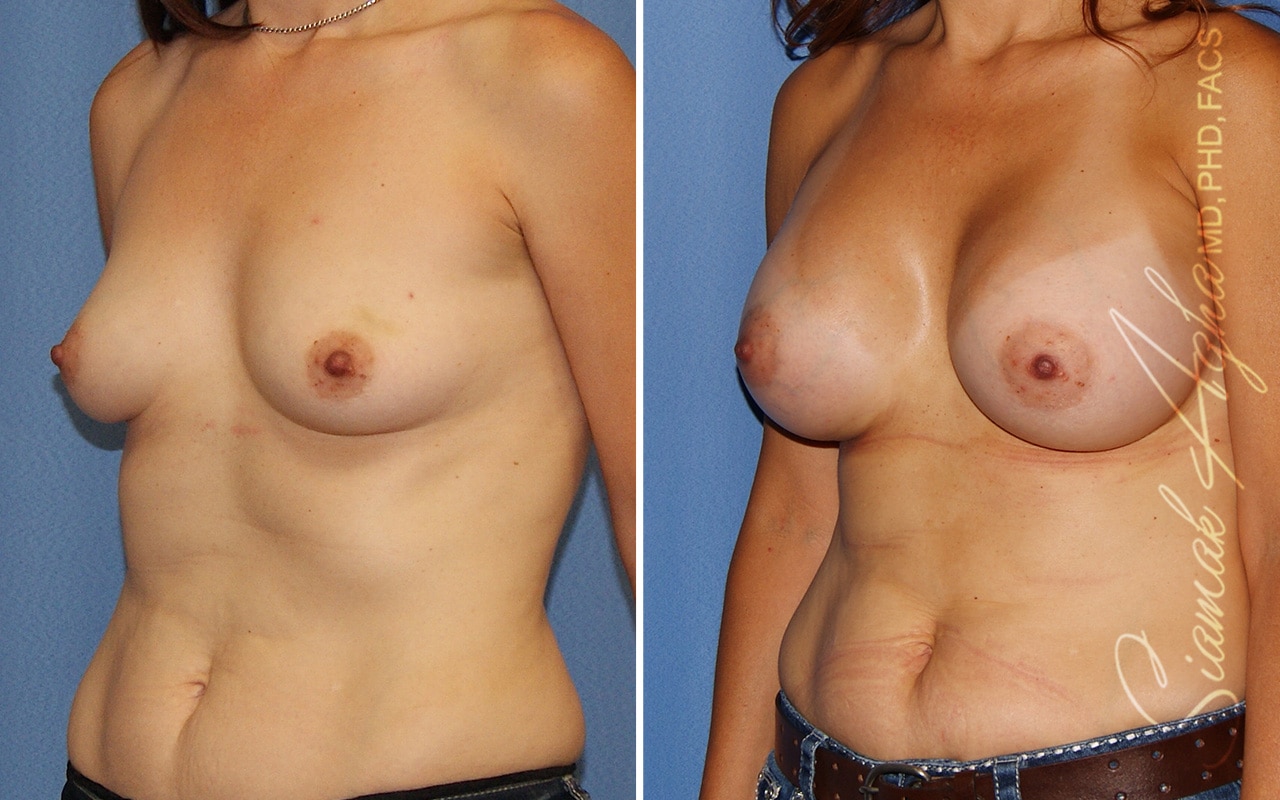 Breast Augmentation Patient 64