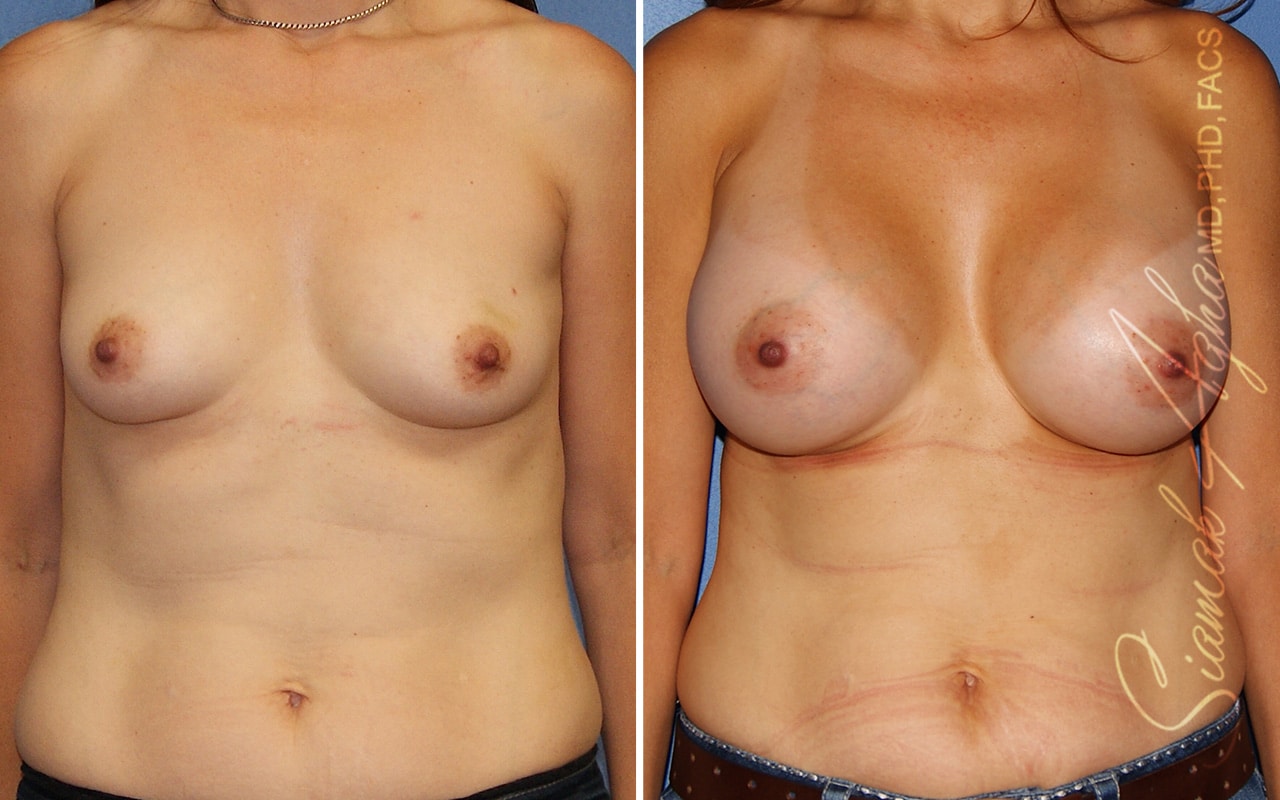 orange county breast augmentation patient 64 front Newport Beach, CA