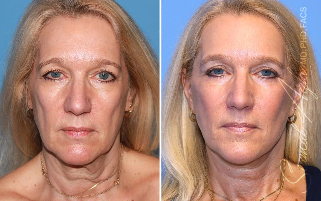 orange county face lift patient 16 front Newport Beach, CA