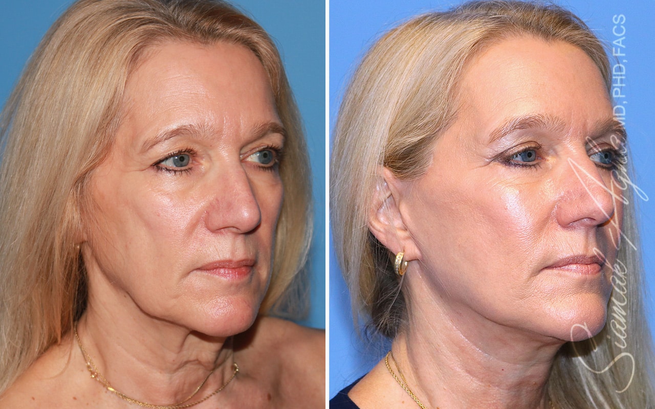 orange county face lift patient 16 front right Newport Beach, CA