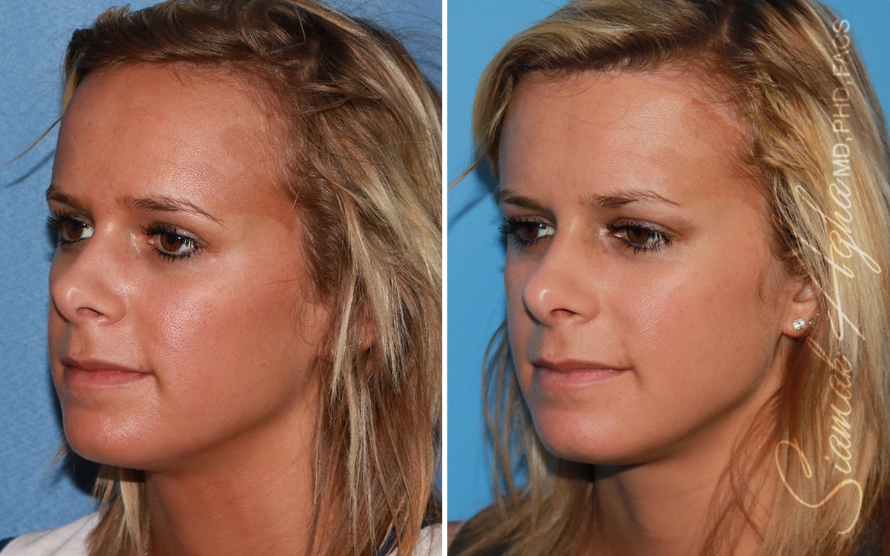 orange county forehead reduction patient 04 front left Newport Beach, CA