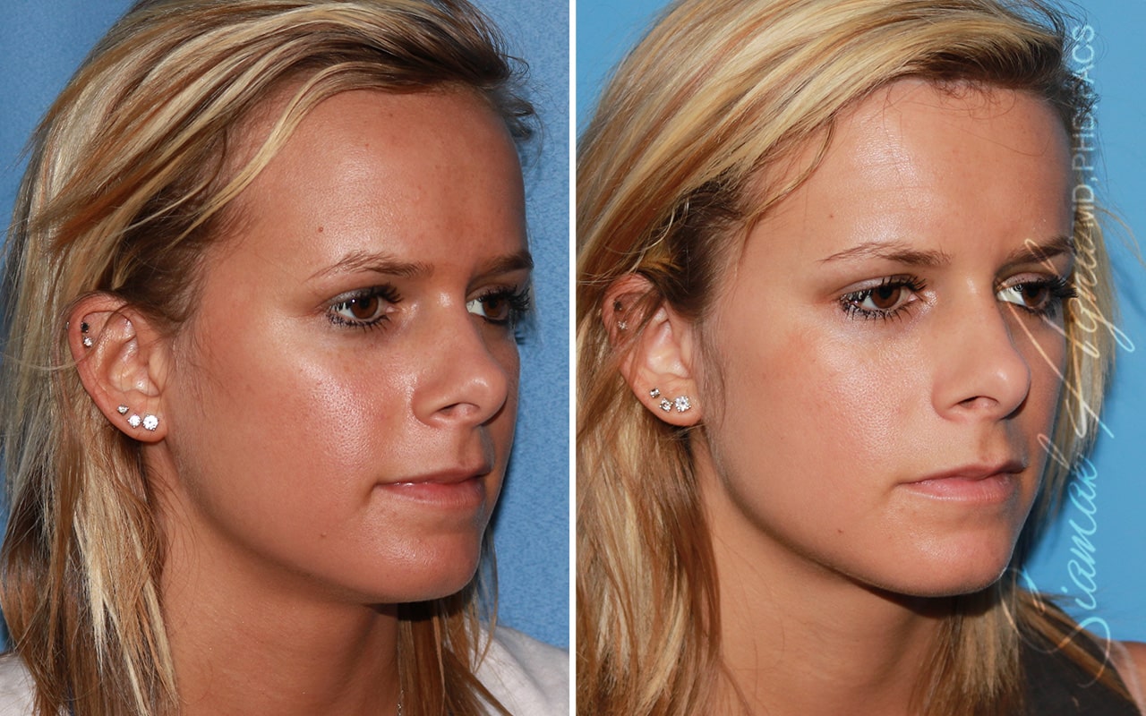Orange County Forehead Reduction Patient 04 Front Right Newport Beach, CA