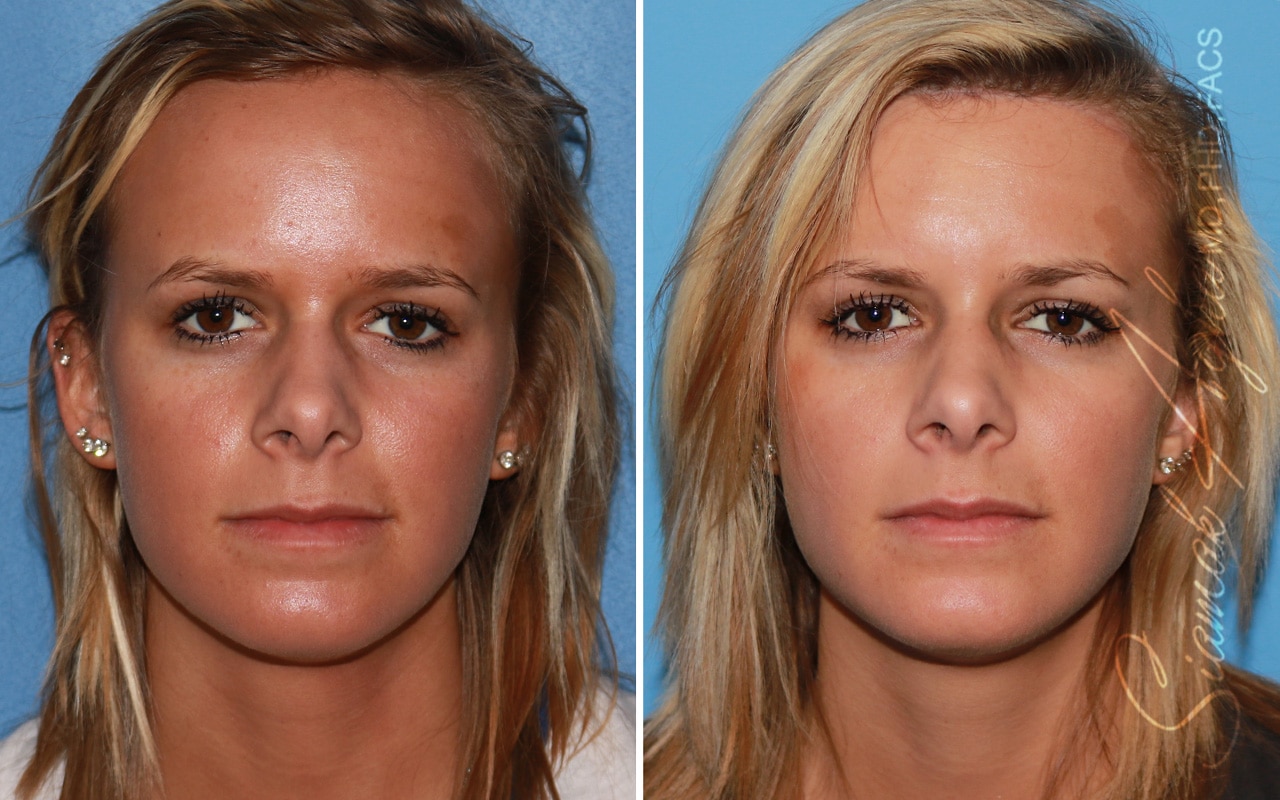 orange county forehead reduction patient 04 front Newport Beach, CA