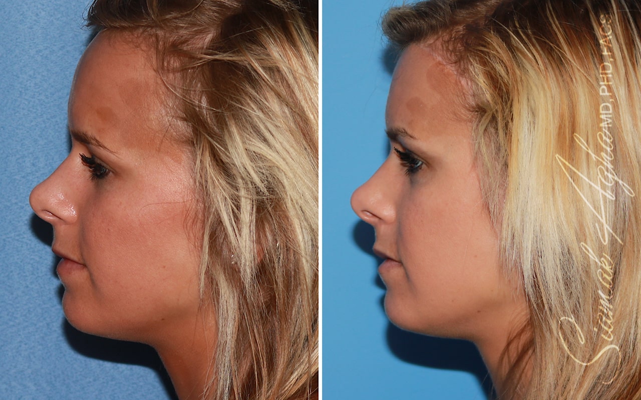 Orange County Forehead Reduction Patient 04 Left Newport Beach, CA