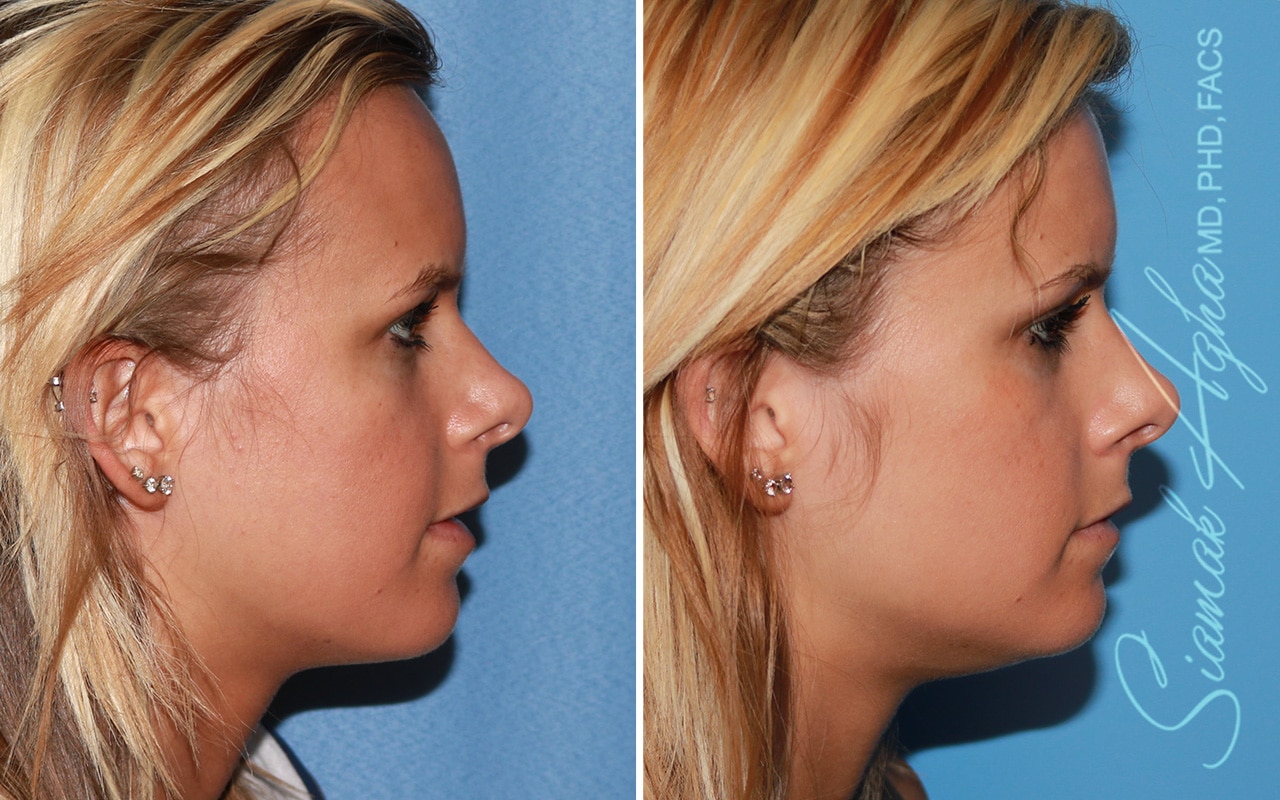 Forehead Reduction Patient 4