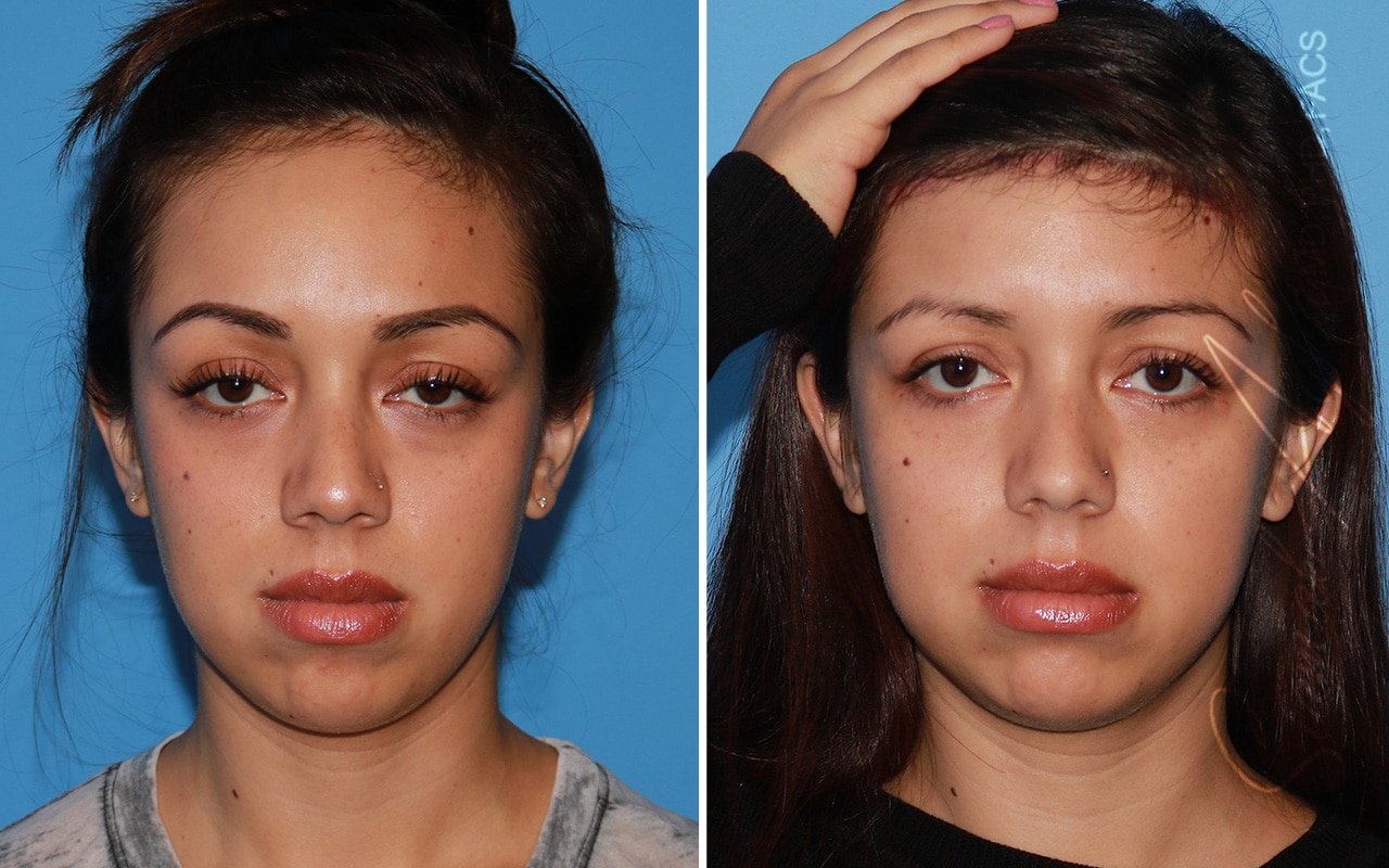 orange county forehead reduction patient 05 front b Newport Beach, CA
