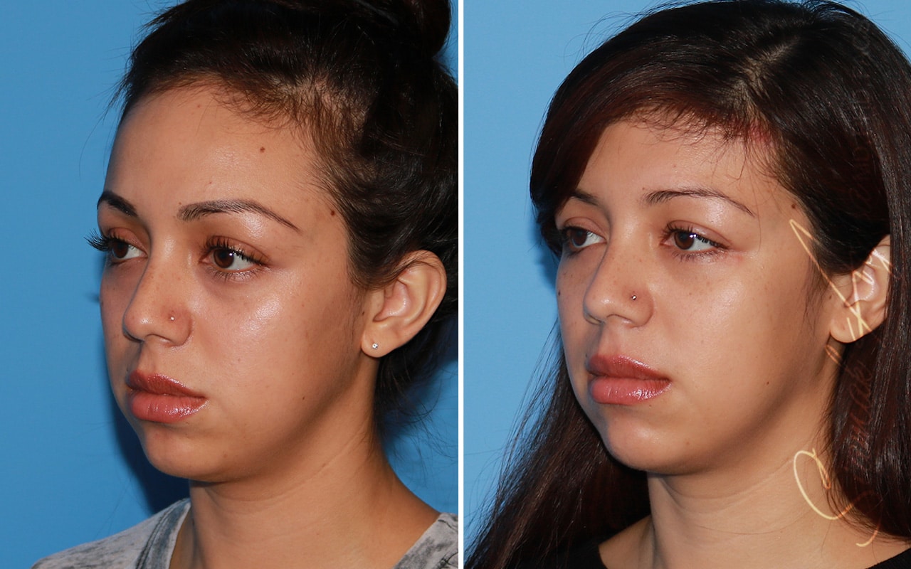orange county forehead reduction patient 05 front left Newport Beach, CA