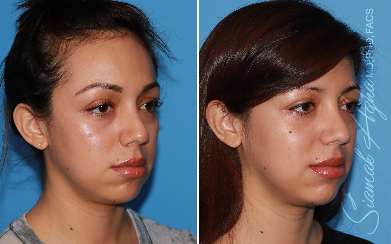 orange county forehead reduction patient 05 front right Newport Beach, CA