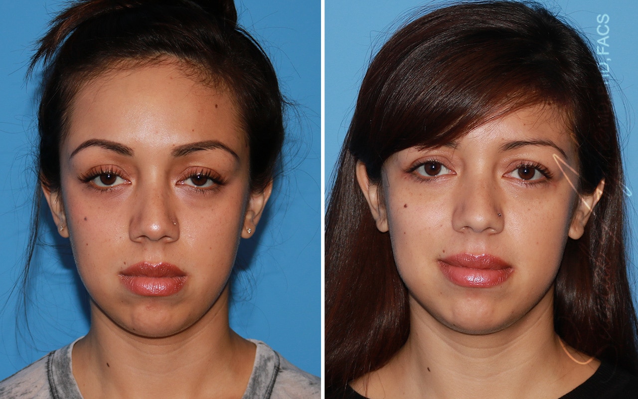 orange county forehead reduction patient 05 front Newport Beach, CA