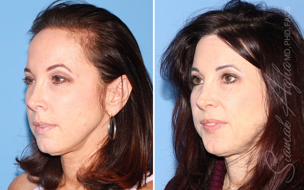 orange county forehead reduction patient 06 front left Newport Beach, CA