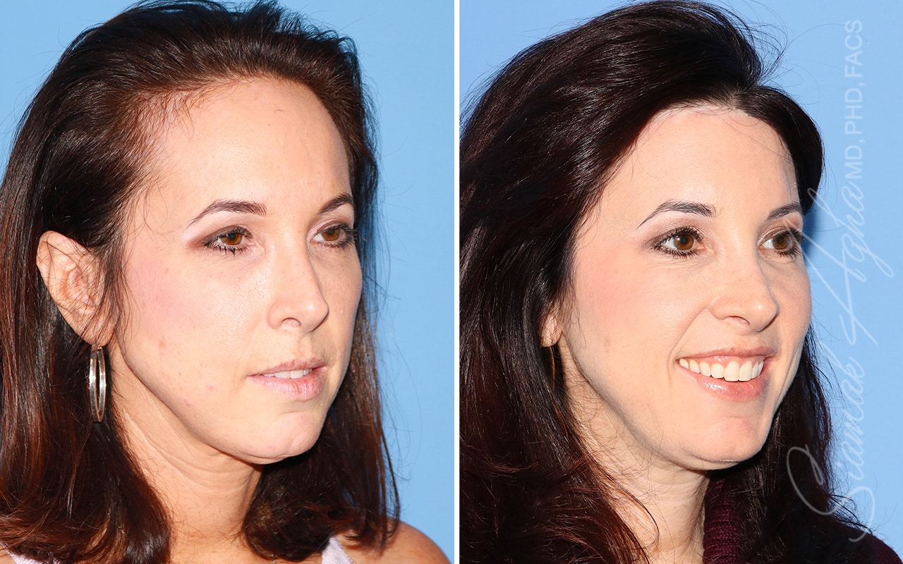 orange county forehead reduction patient 06 front right Newport Beach, CA
