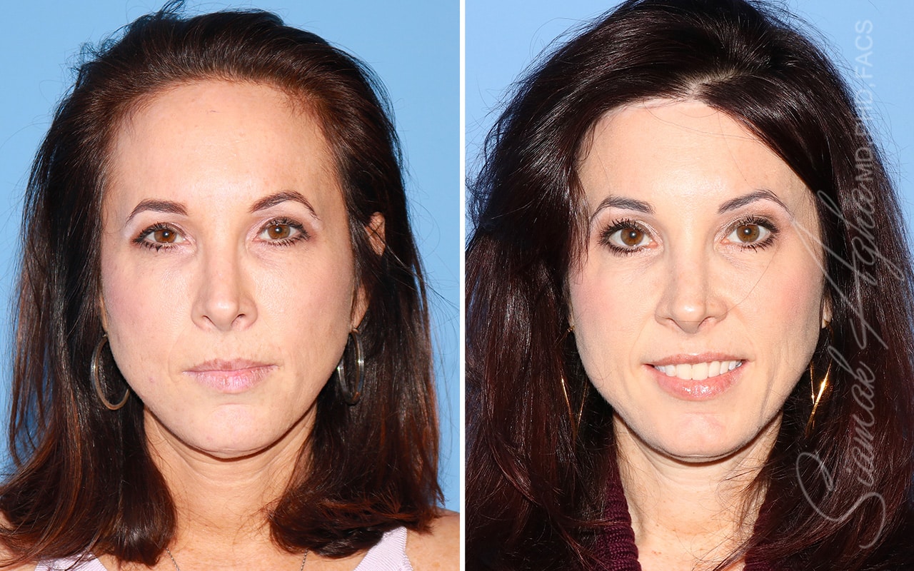 orange county forehead reduction patient 06 front Newport Beach, CA