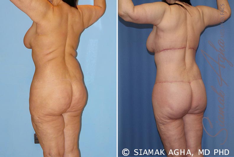 Plastic Surgery Case Study - The Vertical Backlift for Waistline