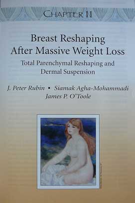 Breast Reshaping After Massive Weight Loss book cover