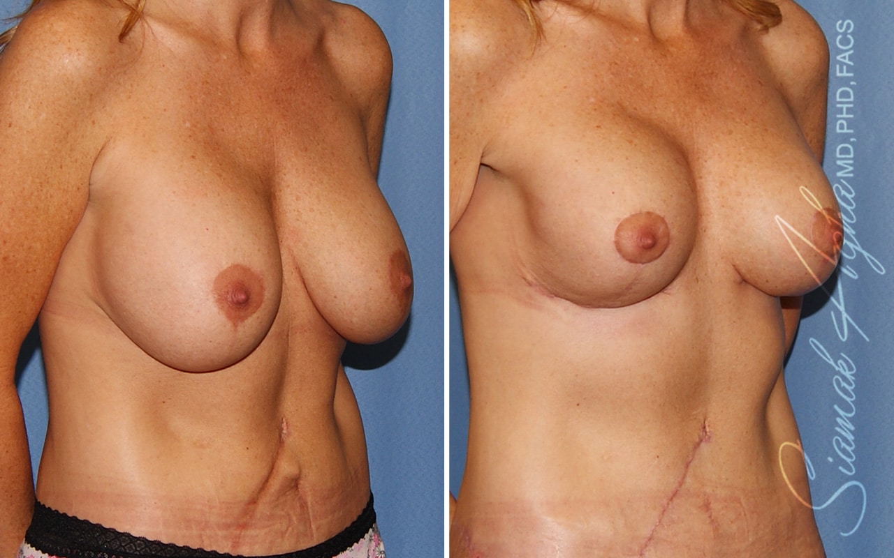 Breast Lift with Augmentation Patient 69