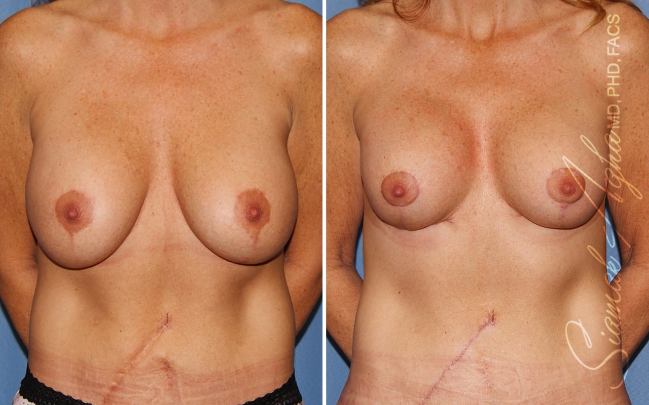 Breast Lift with Augmentation Patient 69