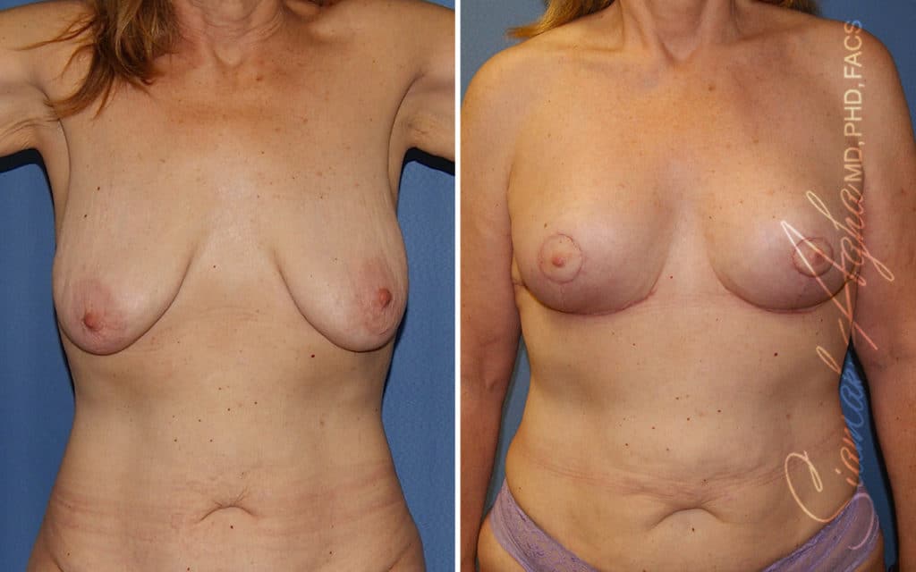 orange county breast lift patient 14 front Newport Beach, CA