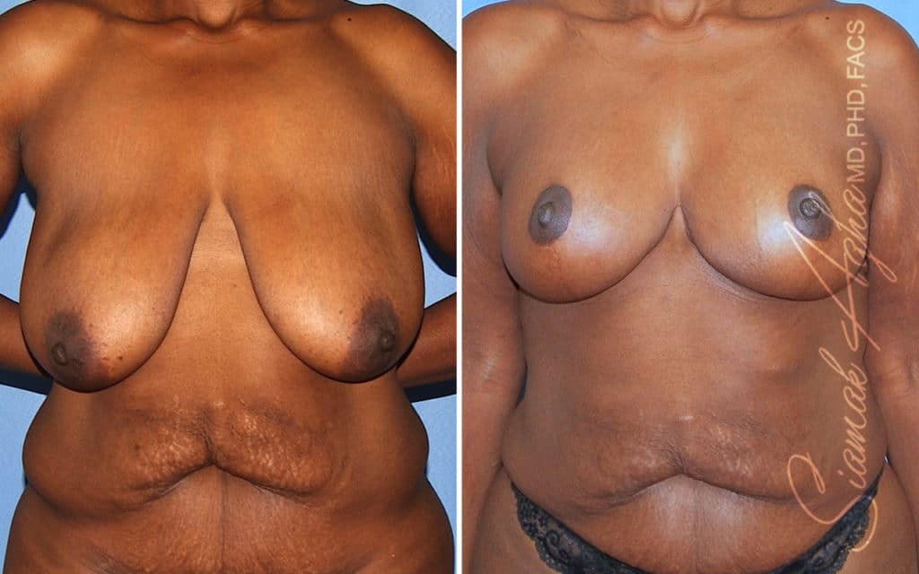 orange county breast lift patient 16 front Newport Beach, CA
