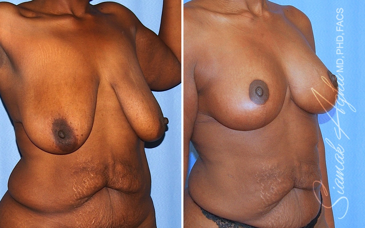Breast Lift Patient 16