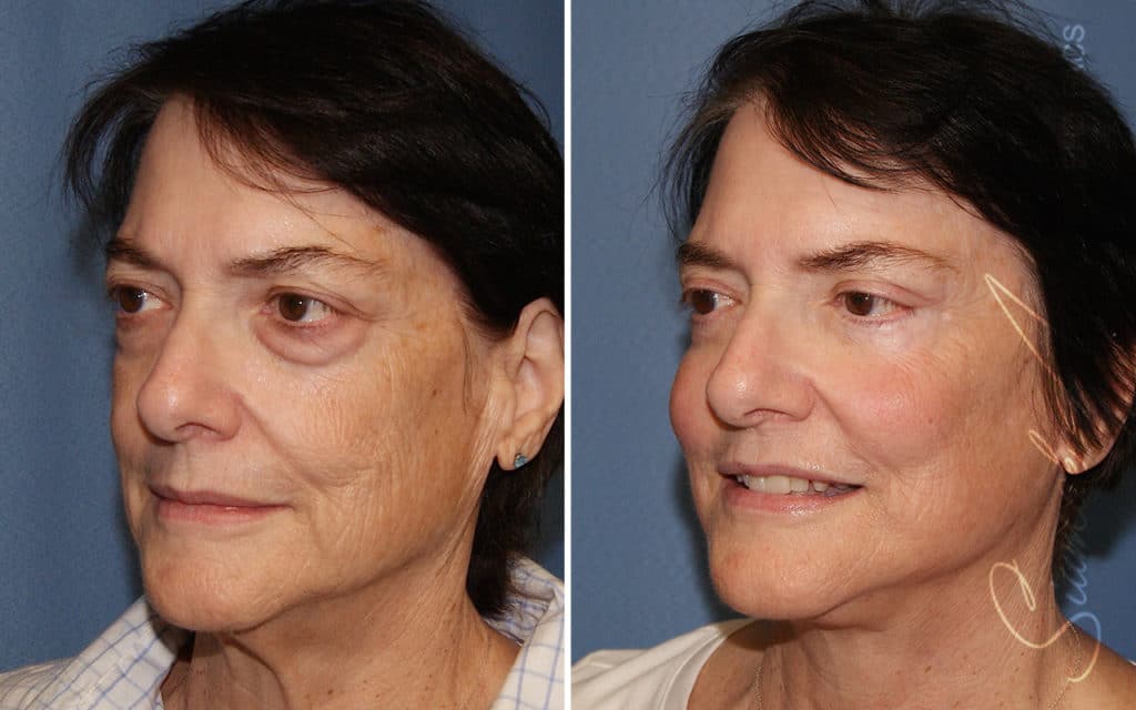 orange county face lift patient 18 front left Newport Beach, CA