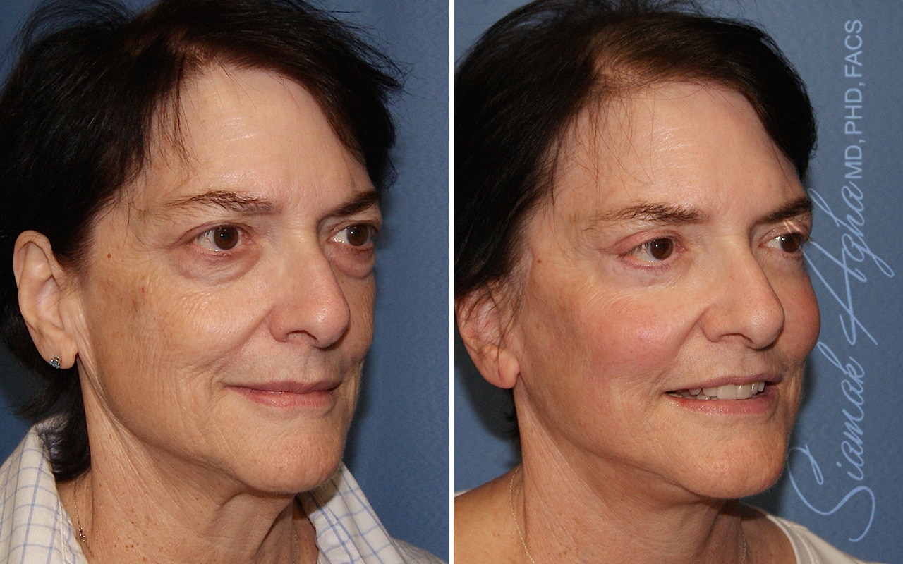 orange county face lift patient 18 front right Newport Beach, CA