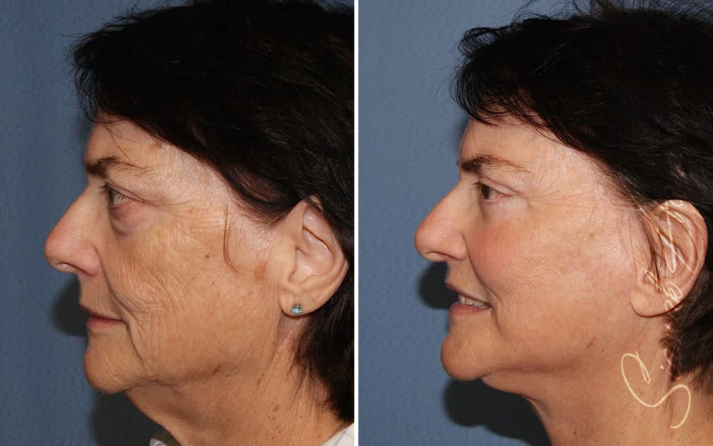 orange county face lift patient 18 left Newport Beach, CA