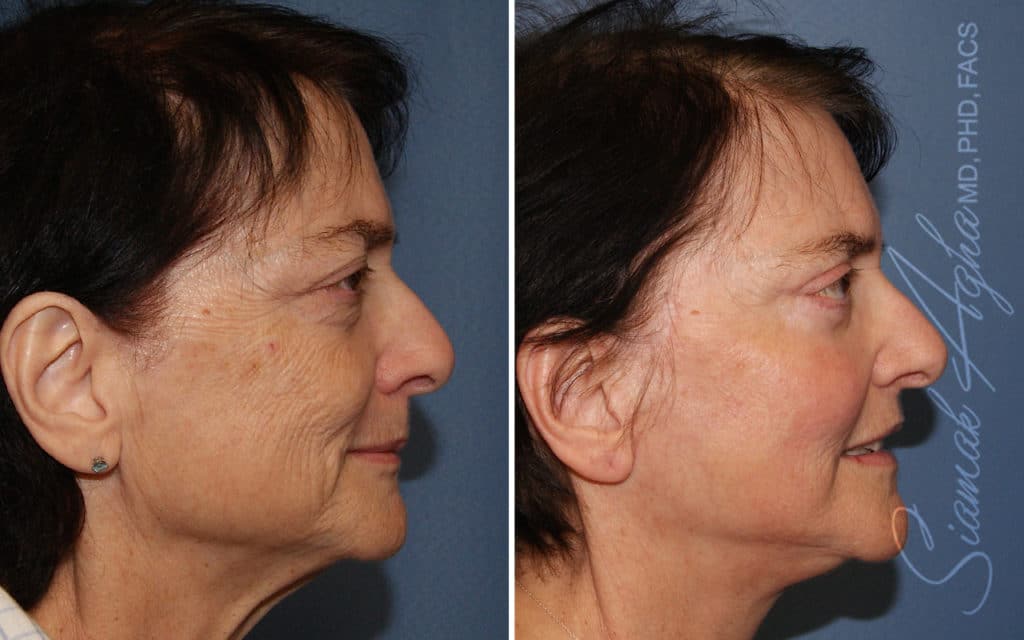 orange county face lift patient 18 right Newport Beach, CA