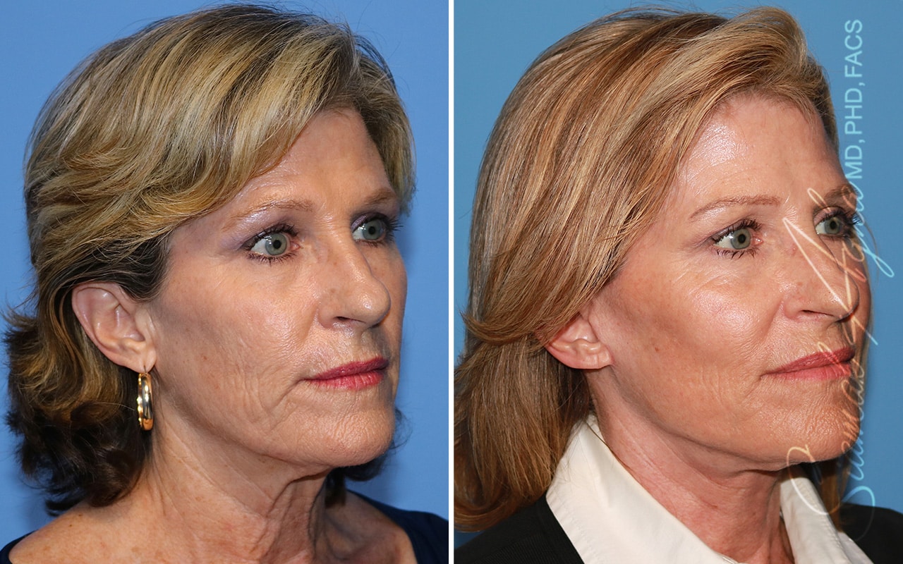 orange county face lift patient 19 front right Newport Beach, CA