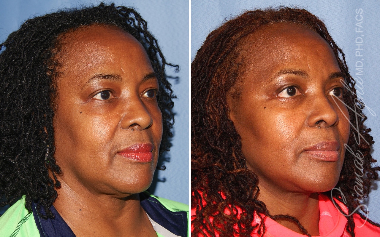 orange county face lift patient 21 front right Newport Beach, CA