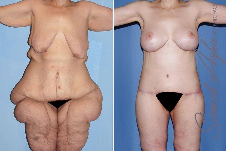 Plastic Surgery After Weight Loss