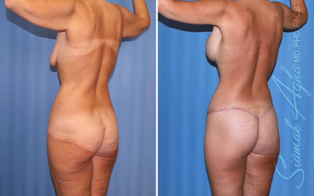 Buttock Augmentation, Reshaping, Lift