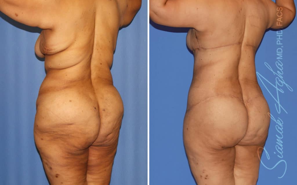 Buttock Augmentation, Reshaping, Lift