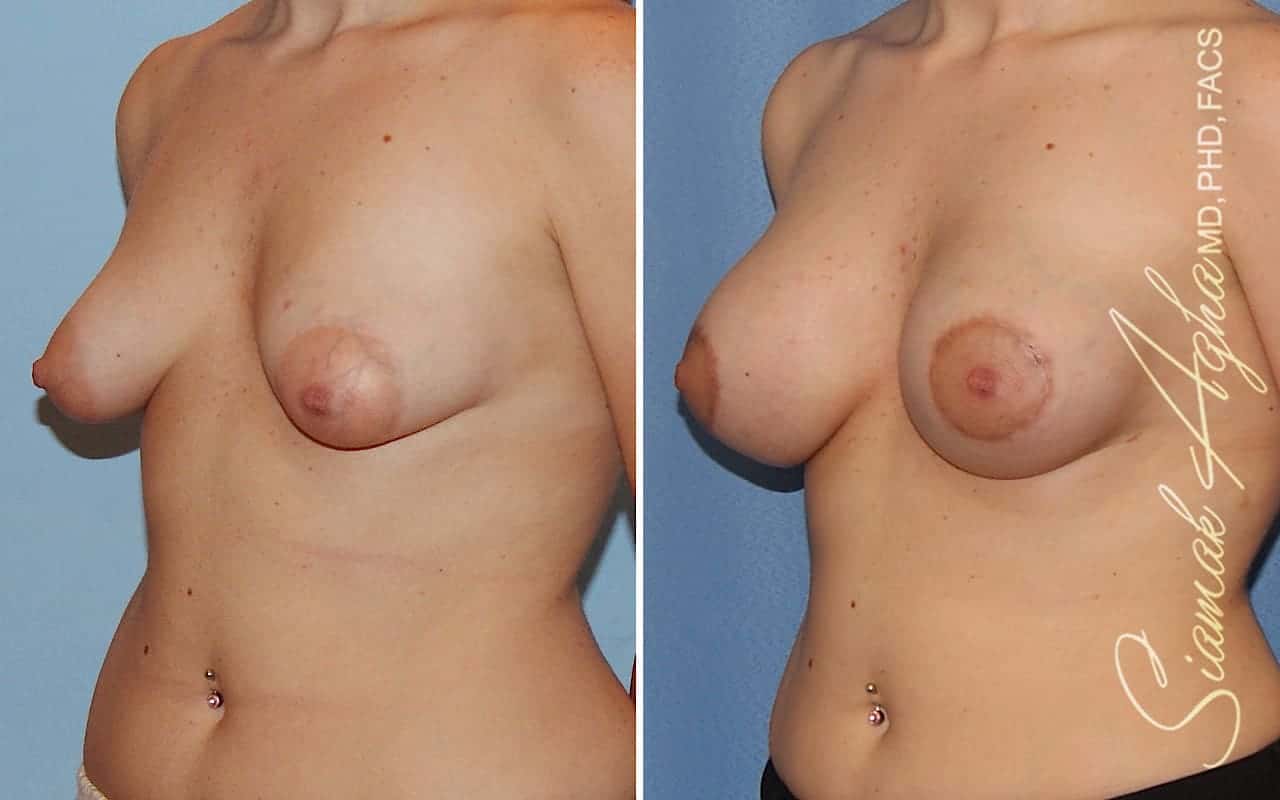 Tubular Breast Correction Patient 7