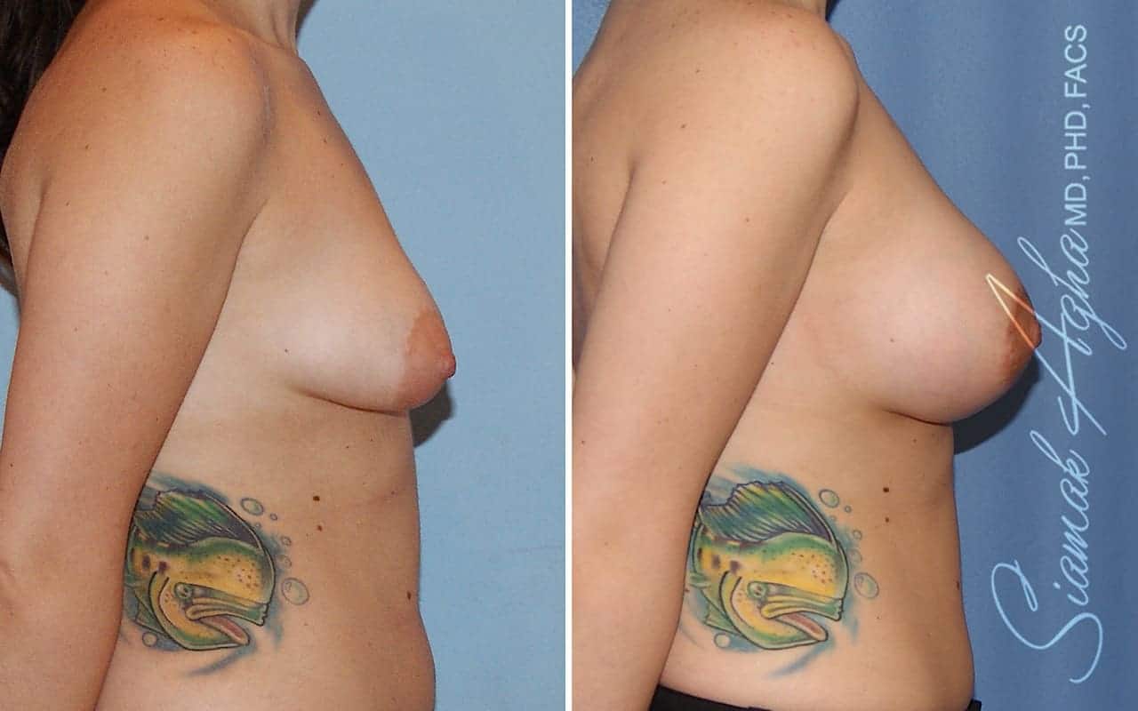 orange county tubular breast correction patient 07 right Newport Beach, CA