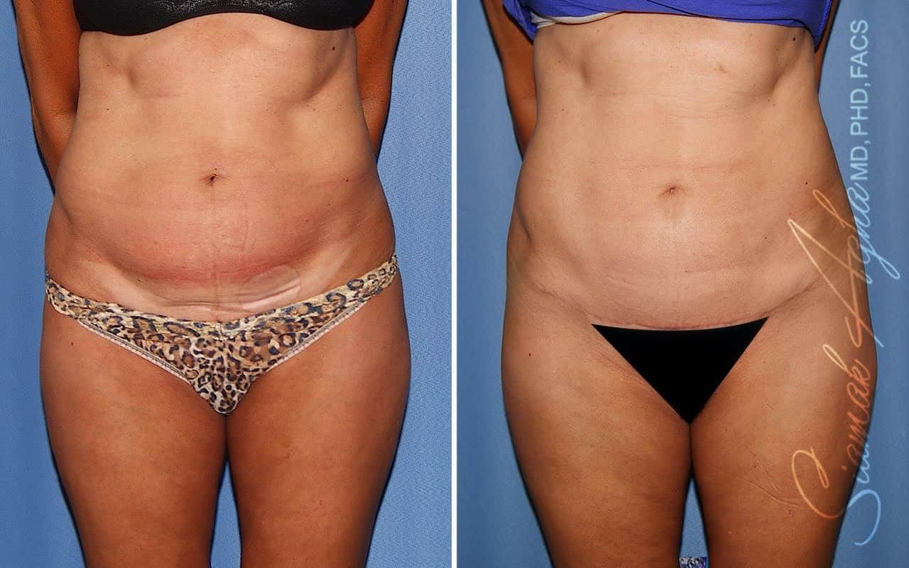 Tummy Procedures Before and After Photo Gallery