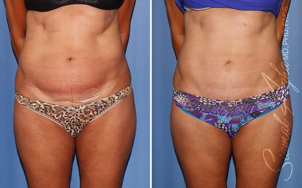 Mini Tummy Tuck Before and After 01