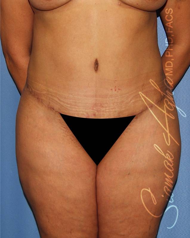 Plus Size Tummy Tuck Surgery Before & After Photo Gallery